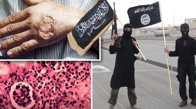 ISIS disease