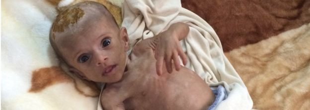 υποσιτισμός Υεμένη